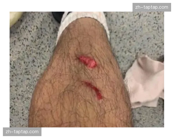 法兰克福前锋巴霍亚大腿受伤缺阵 锋线得分点进一步减少